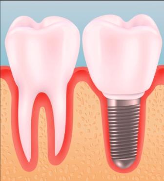 Dental Implant types information