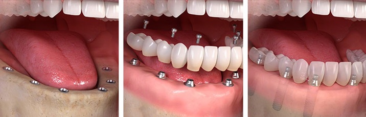 Multiple tooth implant