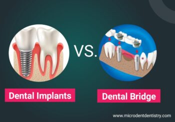 dental implant vs dental bridges