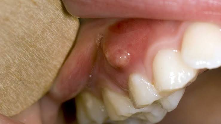Picture of Gum Boil in Adults