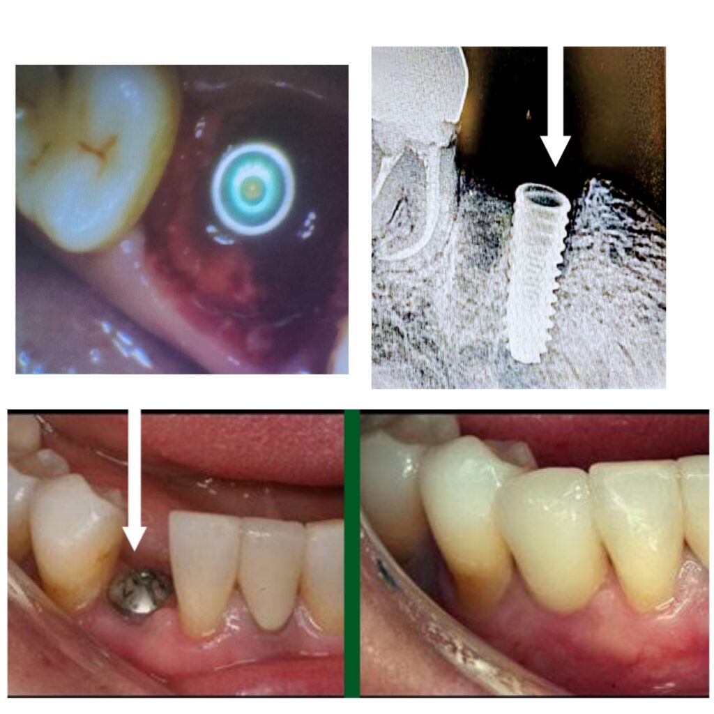 Dental Implant treatment in pune