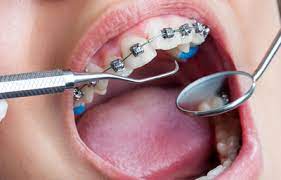Dental Brace treatment