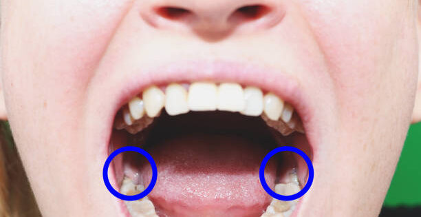 Tooth Removal or Dental Extraction