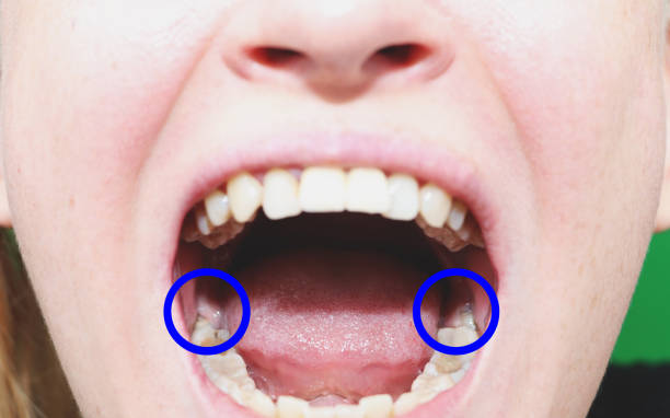 Tooth Removal or Dental Extraction