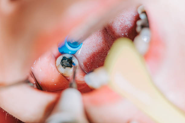 Root Canal Treatment in Kothrud