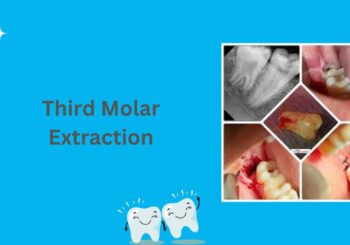 Third Molar Extraction
