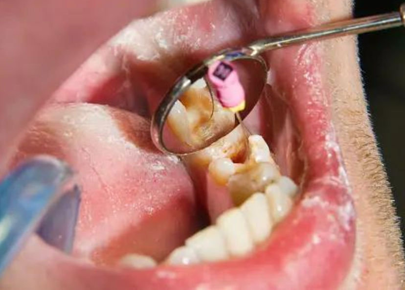  root canal treatment image