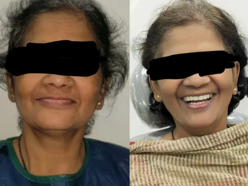 teeth implants in Pune