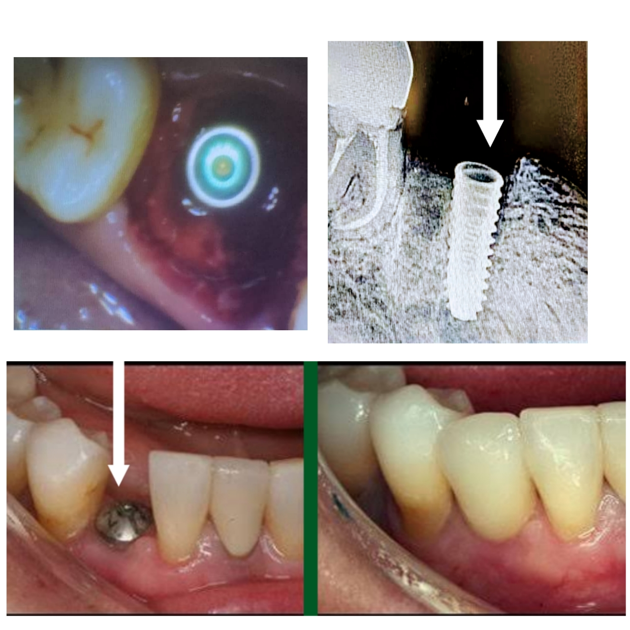 dental implant case at Miicrodent Dentistry, Pune