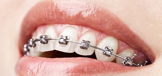 regular metal braces