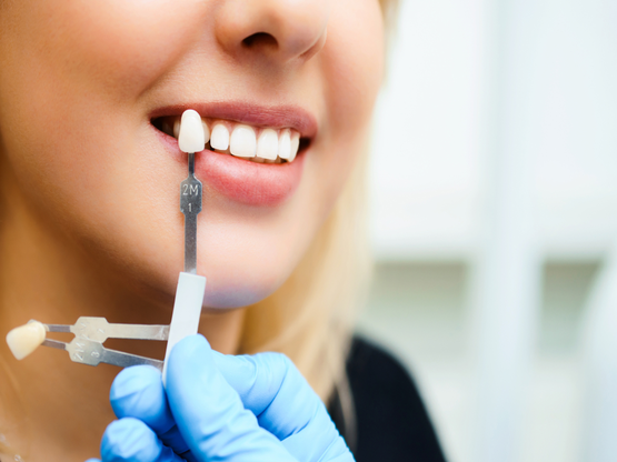  Cosmetic dentistry-teeth whitening