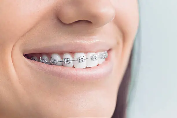 Dental Braces