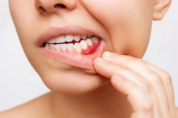 Sensitive Teeth Problem