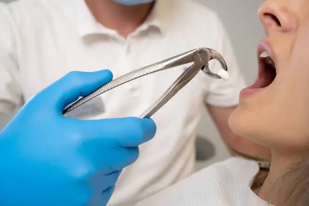 tooth extraction