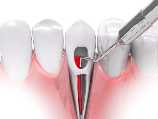 root canal treatment