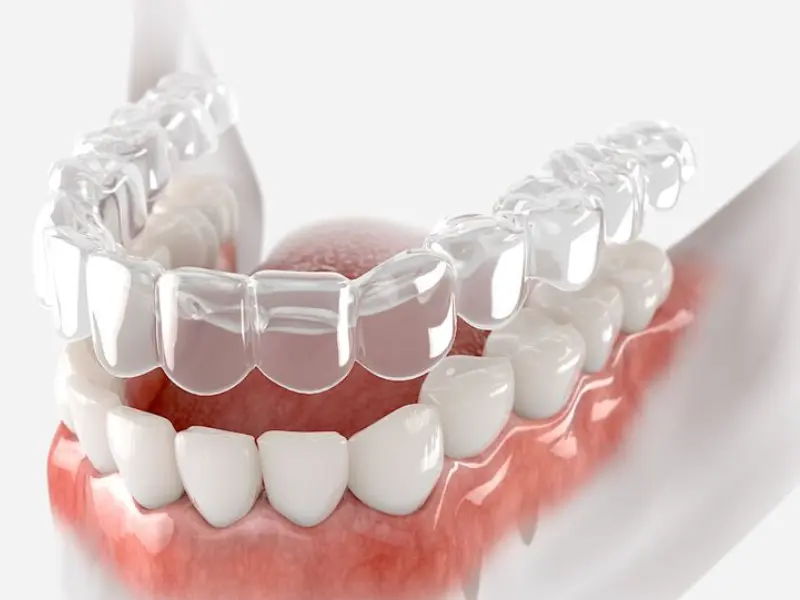 invisalign treatment