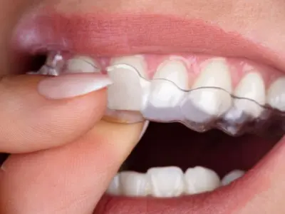 invisalign treatment