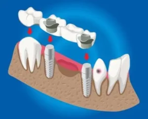 teeth of micro dent work