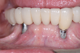 Peri Implantities