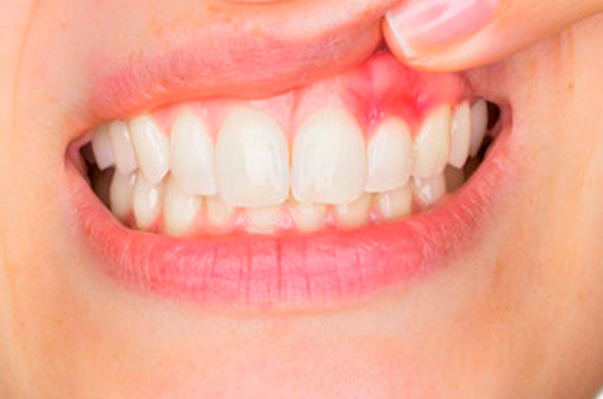 Gum-Disease