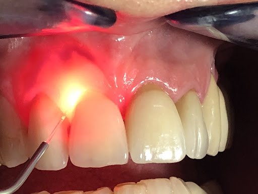 Laser-Gum-Therapy