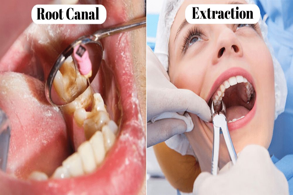 Root Canal Vs Tooth Extraction