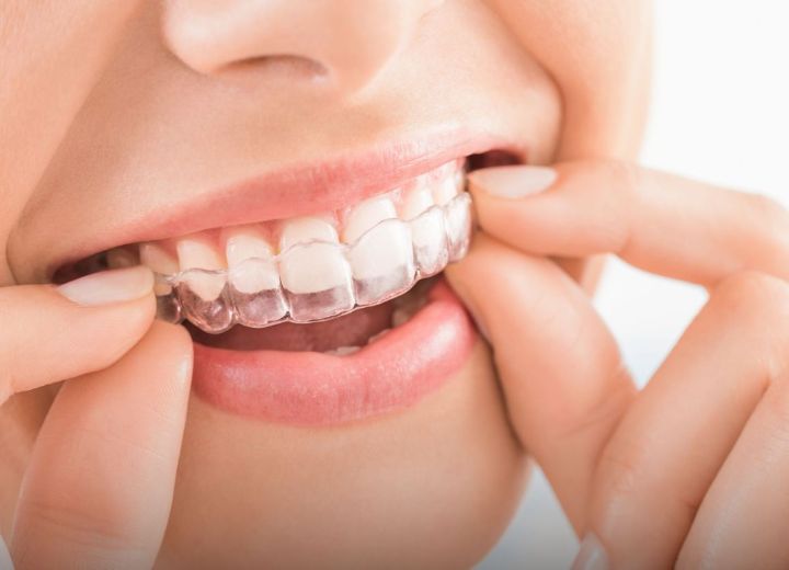 Invisalign