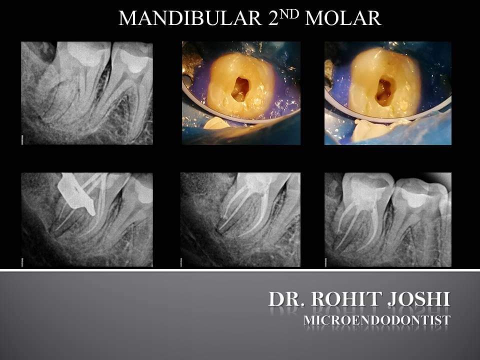 Root Canal Treatment