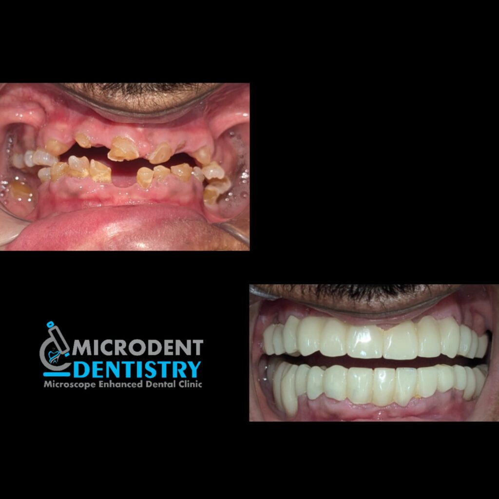 Dental Implants