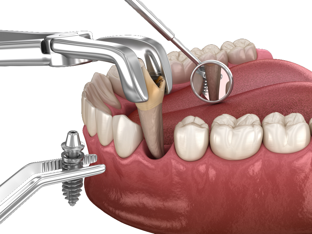 Immediate Loading Implants