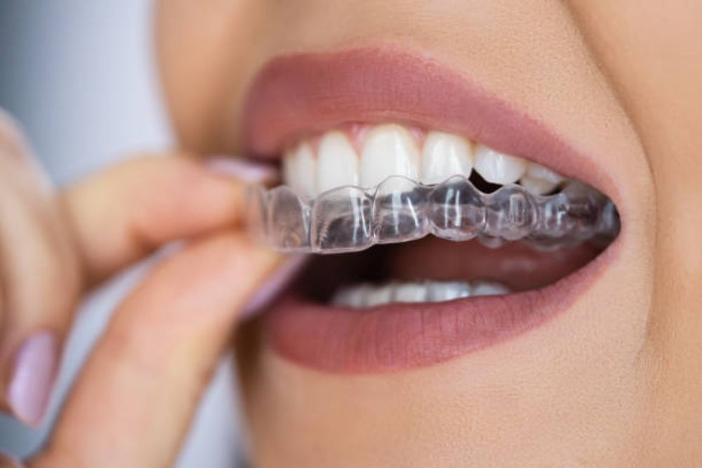 Invisalign Cost In Pune