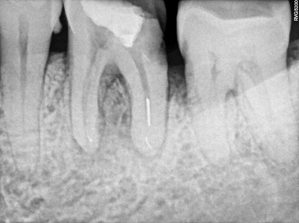 Root Canal Treatment
