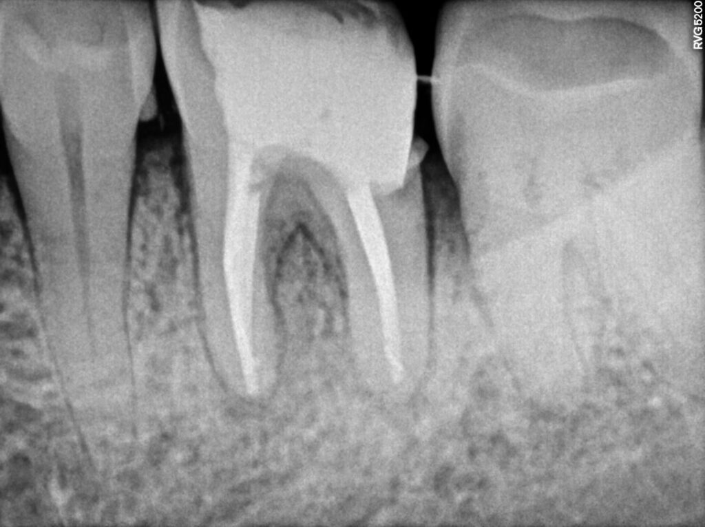 Root Canal with Dental Filling