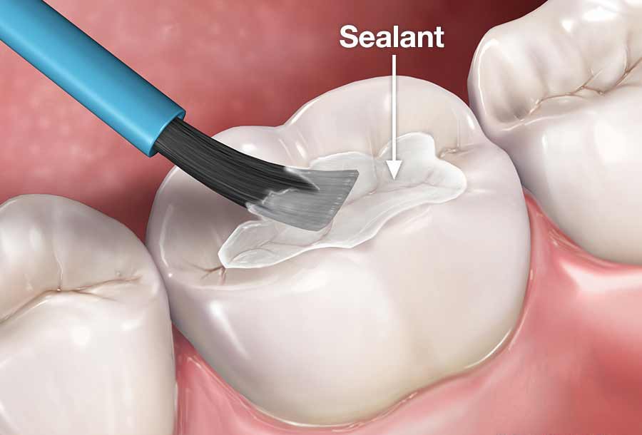 Pit and Fissure Sealants