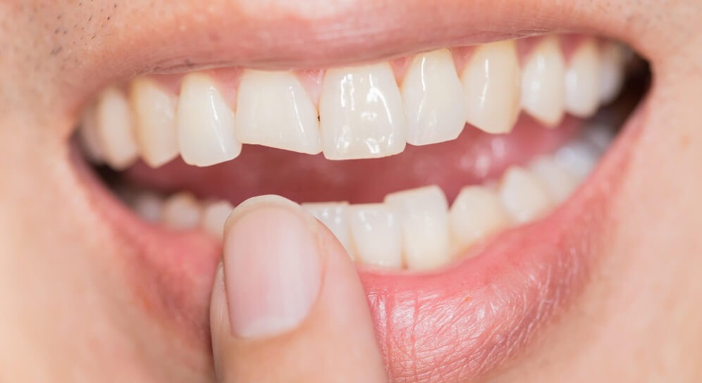 Broken Teeth
