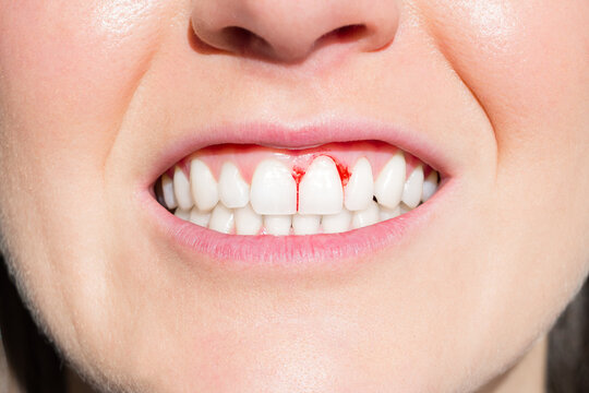Gums Bleed