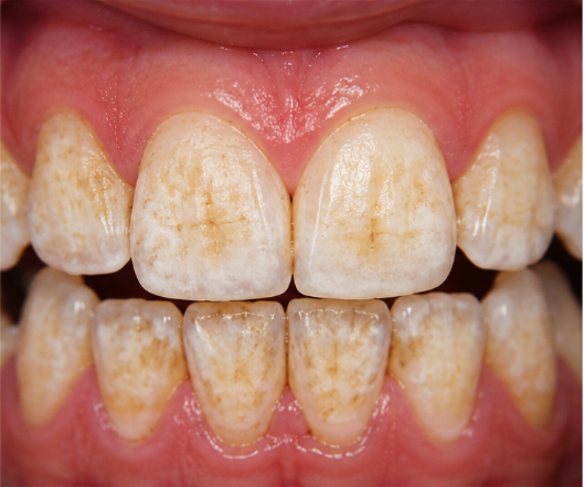 Dental Fluorosis